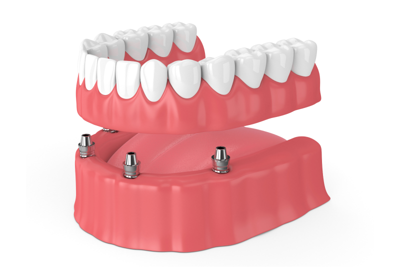 Implant Supported Overdentures